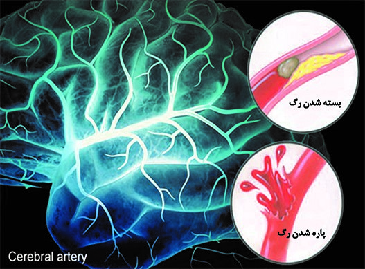 سکته مغزی